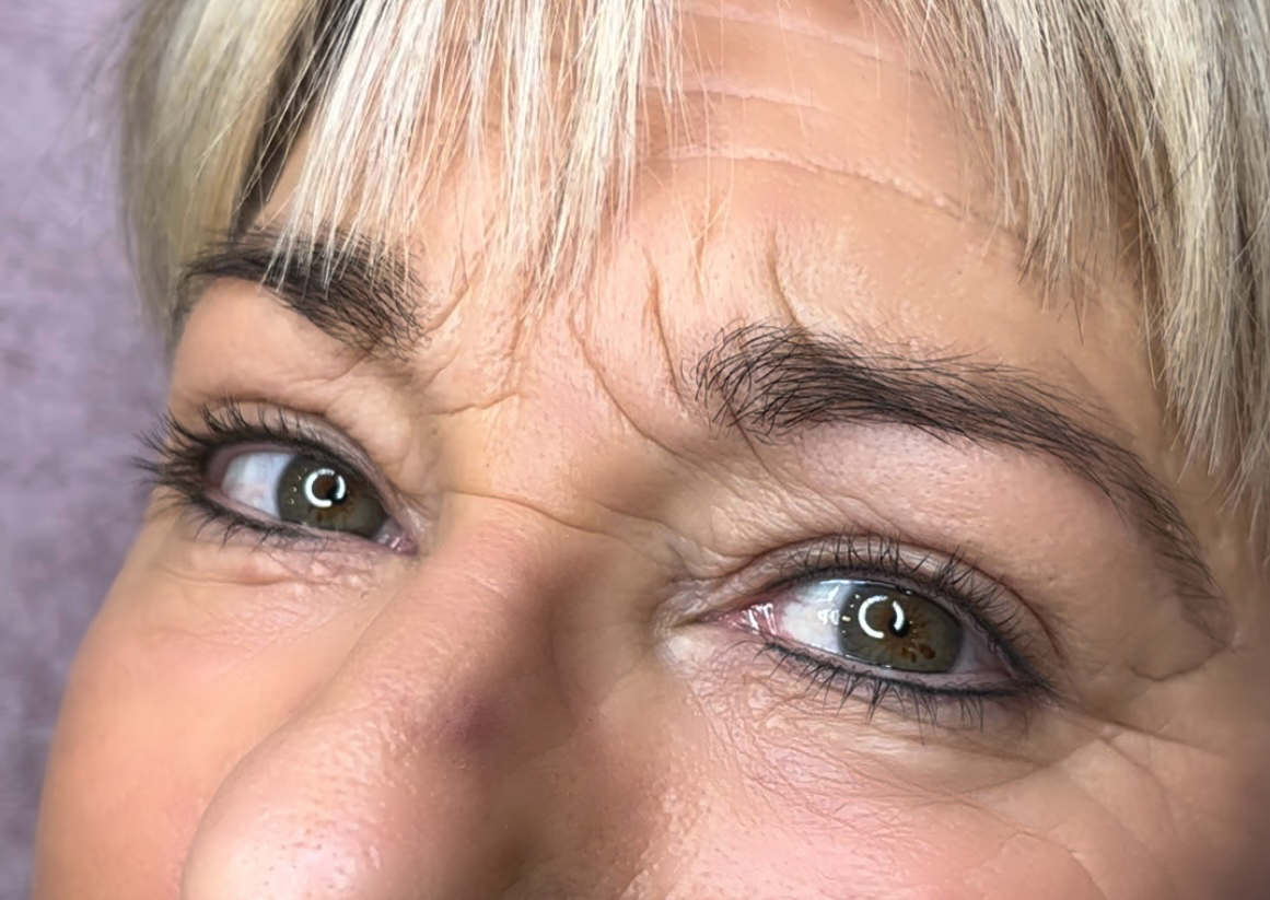 Wimpernkranzverdichtung Detail