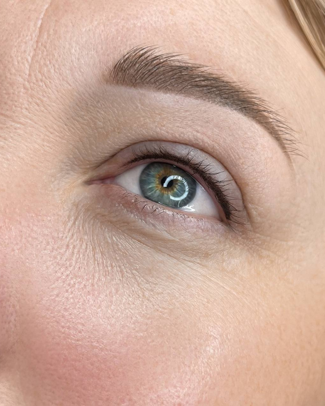 Ergebnis Wimpernkranzverdichtung