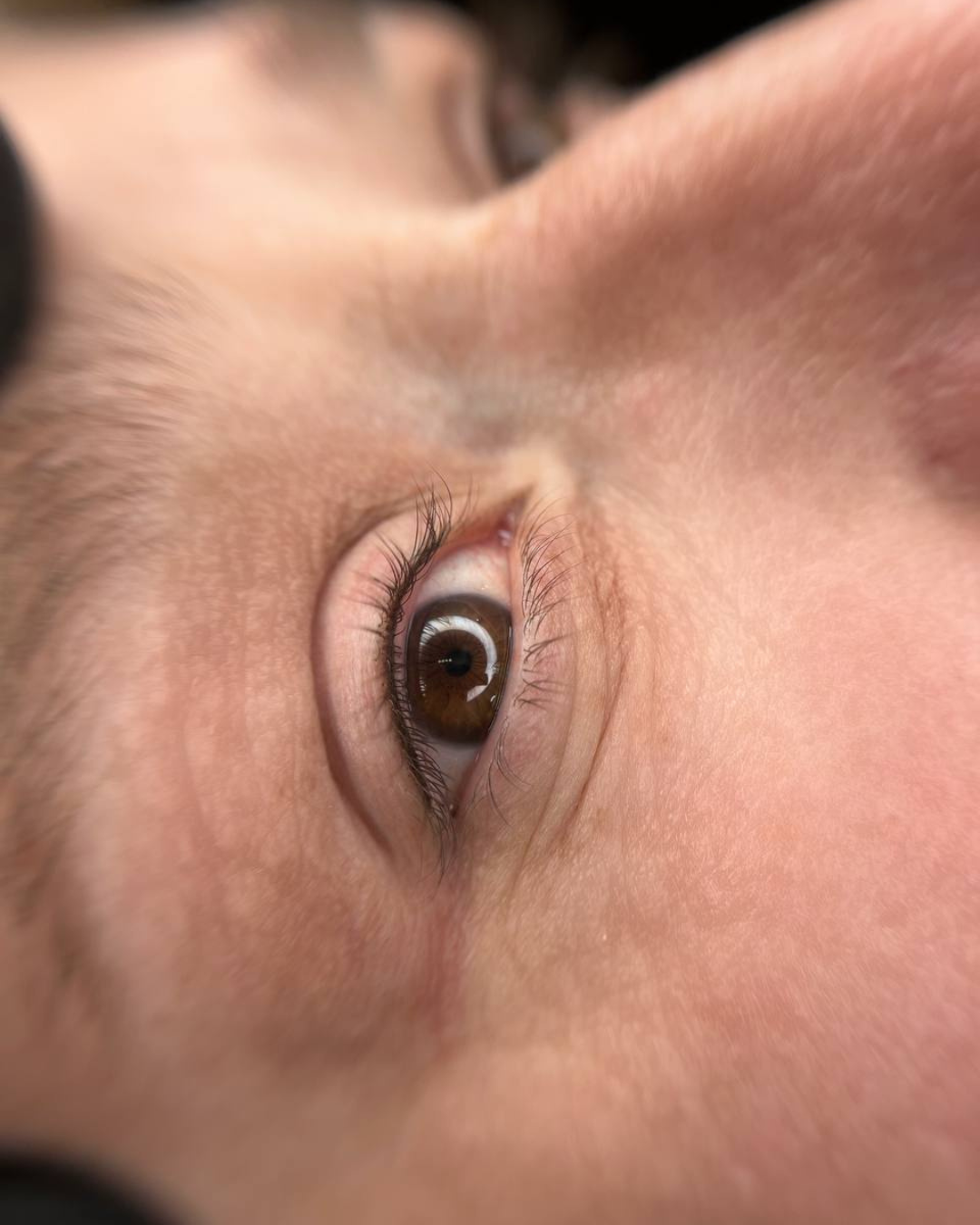 Wimpernkranzverdichtung Behandlungsergebnis
