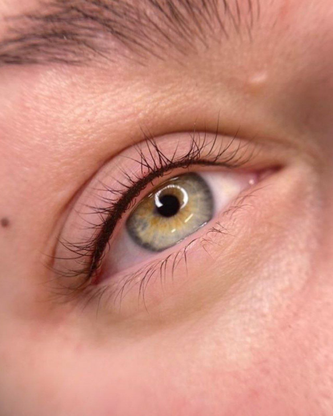 Ergebnis Wimpernkranzverdichtung